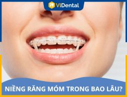 Thời Gian Niềng Răng Móm Trong Bao Lâu Đạt Kết Quả Tốt Nhất?