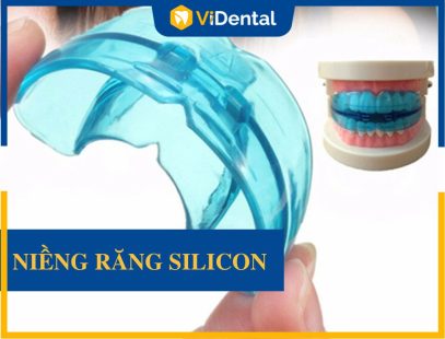 Niềng Răng Silicon: Tất Tần Tật Thông Tin Liên Quan [Xem Ngay]