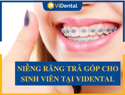 Niềng Răng Trả Góp Cho Sinh Viên Lãi Suất 0% - Bảng Giá Chi Tiết