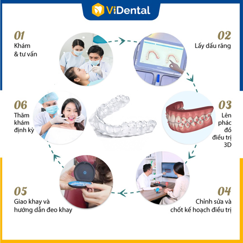 Quy trình chỉnh nha hay niềng trong suốt chuẩn y khoa