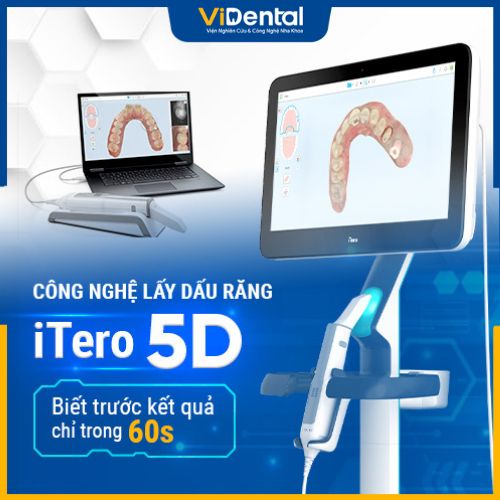 Lấy dấu hàm với công nghệ Itero 5D