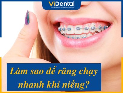 Răng Chạy Nhanh Khi Niềng: Hiệu Quả Và Gợi Ý Tip Tác Động