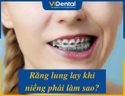 Răng Lung Lay Khi Niềng: Chi Tiết Về Nguyên Nhân, Cách Chữa