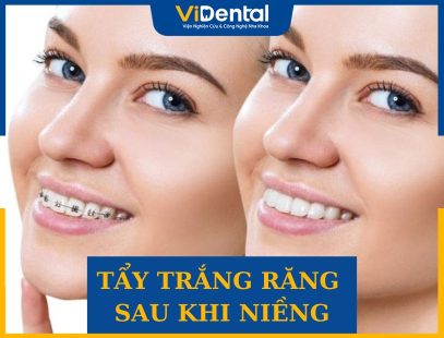 Tẩy Trắng Răng Sau Khi Niềng - Có Nên Không, Cần Lưu Ý Gì?