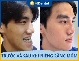 Trước Và Sau Khi Niềng Răng Móm Gương Mặt Thay Đổi Ra Sao?