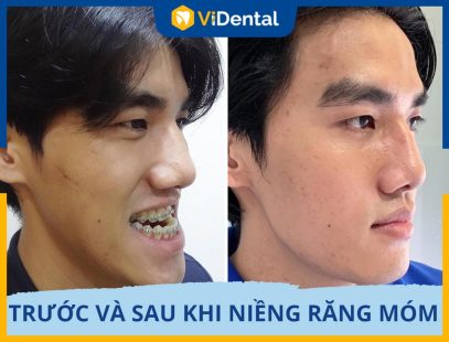 Trước Và Sau Khi Niềng Răng Móm Gương Mặt Thay Đổi Ra Sao?