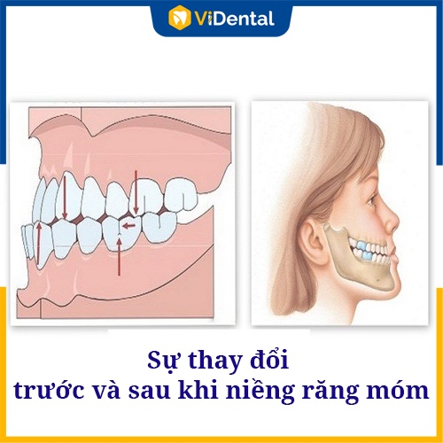 Niềng răng móm sẽ thay đổi gương mặt đáng kinh ngạc