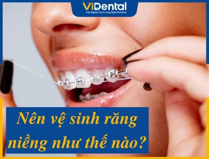 Hướng Dẫn Vệ Sinh Răng Niềng Hiệu Quả Và Một Số Lưu Ý