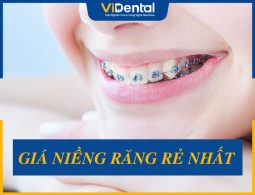 Cập Nhật Giá Niềng Răng Rẻ Nhất, Gợi Ý Địa Chỉ Niềng Uy Tín