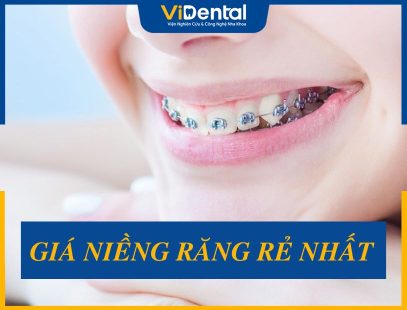 Cập Nhật Giá Niềng Răng Rẻ Nhất, Gợi Ý Địa Chỉ Niềng Uy Tín