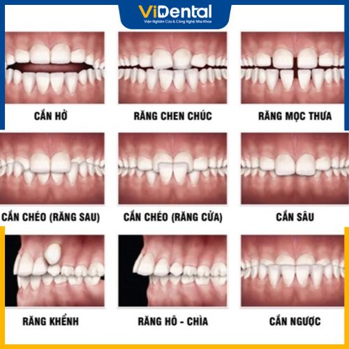 Một số vấn đề răng miệng cần tiến hành bọc răng sứ sau khi niềng răng