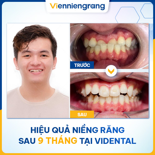 Những trường hợp nhổ răng mang lại sự thay đổi hoàn toàn