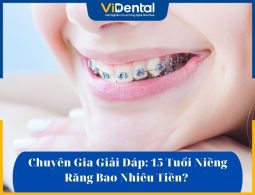 chi phí niềng răng cho trẻ 15 tuổi luôn được nhiều phụ huynh quan tâm