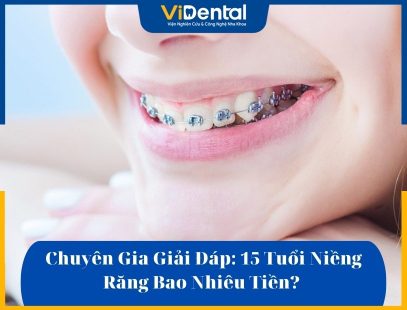 chi phí niềng răng cho trẻ 15 tuổi luôn được nhiều phụ huynh quan tâm