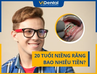 20 Tuổi Niềng Răng Bao Nhiêu Tiền