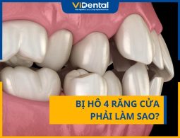 Bị Hô 4 Răng Cửa Phải Làm Sao