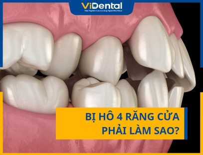 Bị Hô 4 Răng Cửa Phải Làm Sao