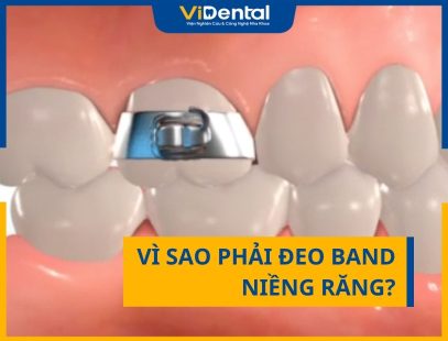 Band Niềng Răng Là Gì? Vì Sao Phải Đeo Band Niềng Răng?