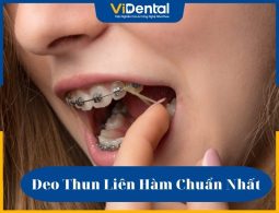 Đeo thun liên hàm như thế nào cho chuẩn?