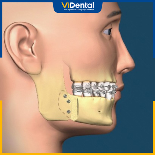 Niềng răng kết hợp phẫu thuật mang đến hiệu quả triệt để