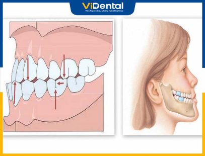 Khớp Cắn Ngược: Cách Nhận Biết Và Điều Trị Hiệu Quả