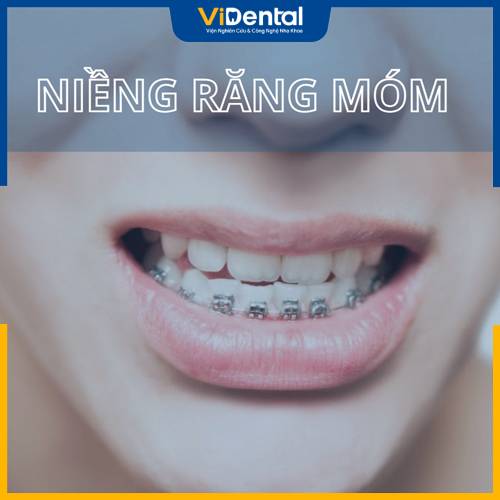 Nhiều người thắc mắc: Bị móm có nên niềng răng?