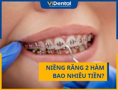 Niềng Răng Bao Nhiêu Tiền 2 Hàm