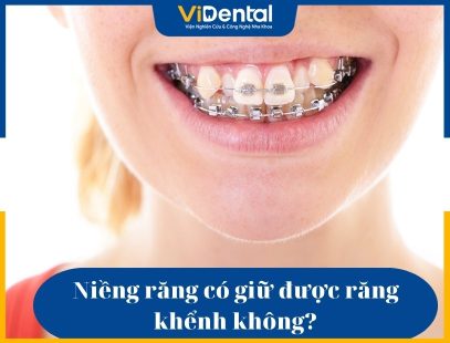 Niềng răng có giữ được răng khểnh không được rất nhiều khách hàng quan tâm