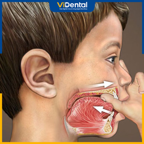 Các thói quen xấu có thể dẫn đến hô nhẹ ở trẻ nhỏ