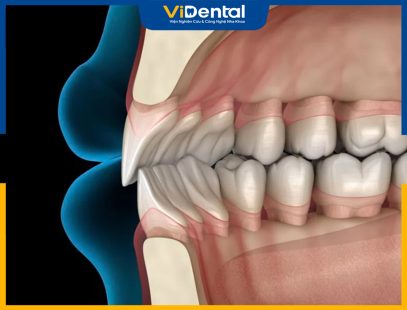 Tình Trạng Răng Hô Nhẹ Và 3 Phương Pháp Điều Trị Hiệu Quả