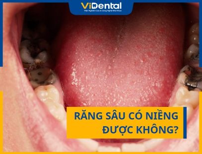 Răng Sâu Có Niềng Được Không?