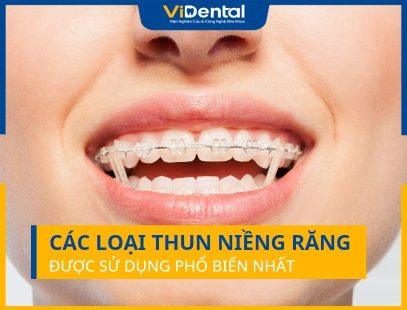 Các Loại Thun Niềng Răng Được Sử Dụng Phổ Biến Nhất 2023