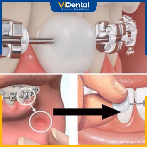 Khi bôi sáp nha khoa lên đầu mắc cài, bạn cần chú ý vệ sinh răng miệng và tay sạch sẽ để ngăn ngừa vi khuẩn