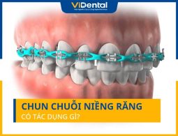 Chun Chuỗi Niềng Răng Có Tác Dụng Gì