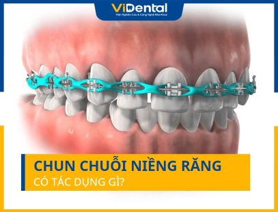 Chun Chuỗi Niềng Răng Có Tác Dụng Gì