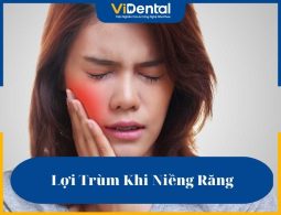 Lợi trùm khi niềng răng là một loại bệnh lý nguy hiểm, cần được phát hiện và điều trị kịp thời