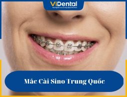 Mắc cài Sino Trung Quốc ra đời với nhiều ưu điểm nổi bật giúp hoàn thiện những khuyết điểm còn thiếu của phương pháp truyền thống