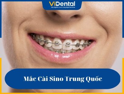 Mắc cài Sino Trung Quốc ra đời với nhiều ưu điểm nổi bật giúp hoàn thiện những khuyết điểm còn thiếu của phương pháp truyền thống