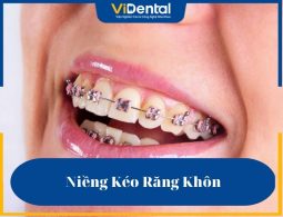 Niềng Kéo Răng Khôn: Ưu - Nhược Điểm, Phương Pháp Và Lưu Ý