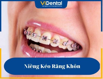 Niềng Kéo Răng Khôn: Ưu - Nhược Điểm, Phương Pháp Và Lưu Ý