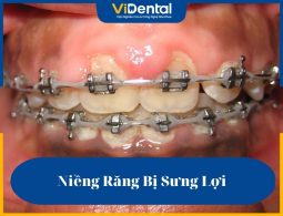 Niềng răng bị sưng lợi là vấn đề thường gặp trong quá trình chỉnh nha