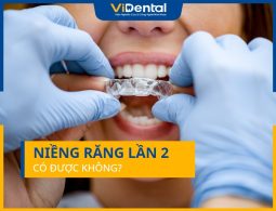 Có Niềng Răng Lần 2 Được Không? Chi Phí Điều Trị Bao Nhiêu?