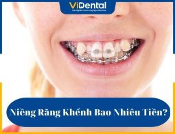 Chi phí niềng răng khểnh là vấn đề mà khách hàng cân nhắc nhiều nhất khi có nhu cầu chỉnh nha