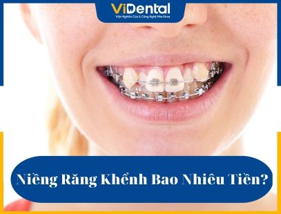 Chi phí niềng răng khểnh là vấn đề mà khách hàng cân nhắc nhiều nhất khi có nhu cầu chỉnh nha