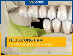 Bị Tình Trạng Tiêu Xương Hàm Có Niềng Răng Được Không?