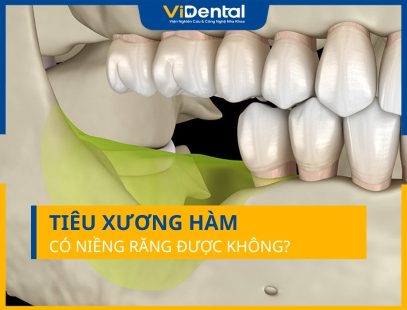 Bị Tình Trạng Tiêu Xương Hàm Có Niềng Răng Được Không?