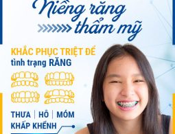 Niềng Răng thẩm mỹ là gì?