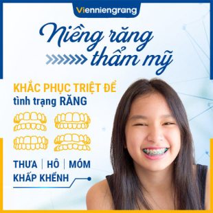 Niềng Răng thẩm mỹ là gì?