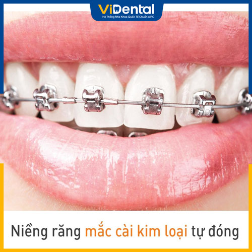 Niềng răng hô mắc cài tự đóng cho hiệu quả tốt