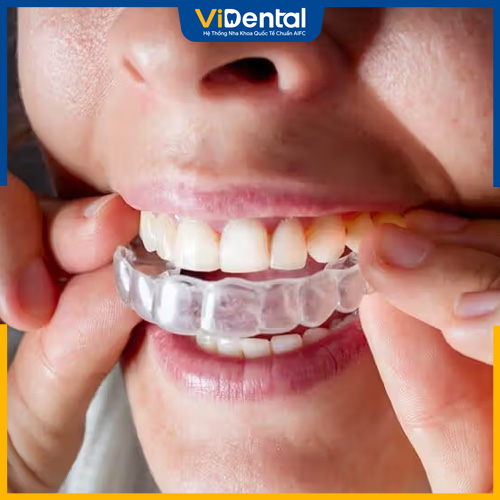 Niềng răng Invisalign được ưa chuộng nhất hiện nay